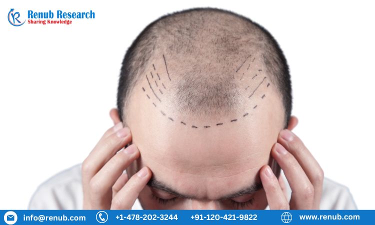 Hair Transplant Market Size Forecast 2023 2028 Industry Trends Growth Share Outlook Impact of Inflation Opportunity Company Analysis